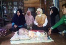 Balita Pengidap Spina Bifida dan Hydrocepalus Ulu Benteng, Diawasi Tim Medis.