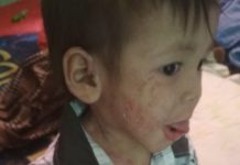 Balita yatim piatu pengidap penyakit kulit warga Sungai Tabuk, perlu uluran tangan dermawan